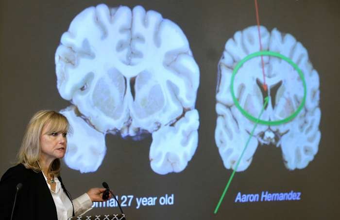 What to Know About CTE: The Brain Disease Behind NFL Controversy